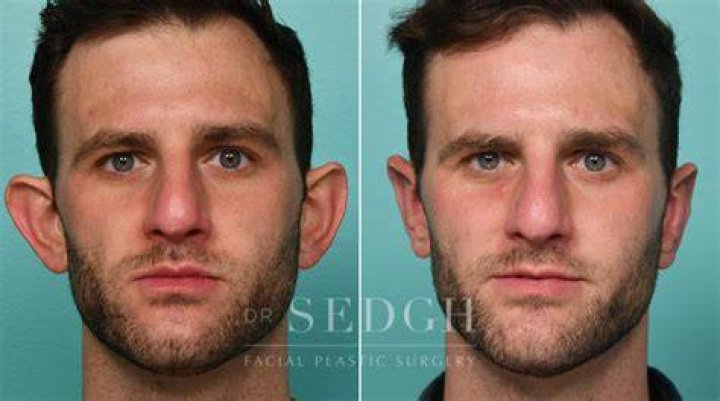 Can ears go back to normal after otoplasty?