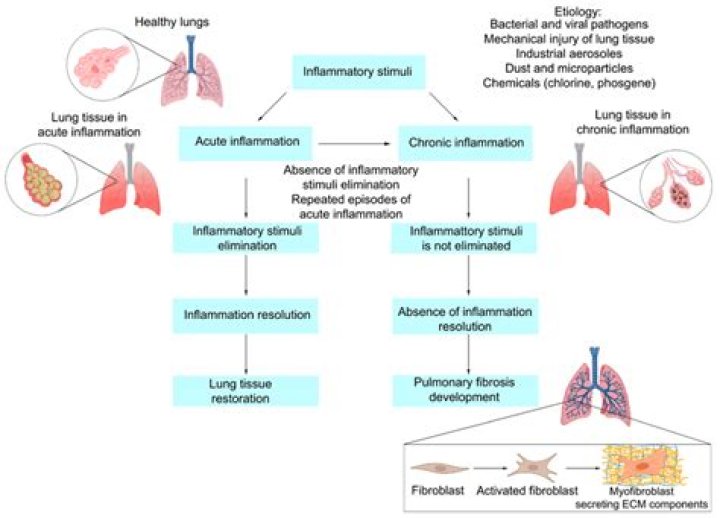 Can pulmonary fibrosis be misdiagnosed?