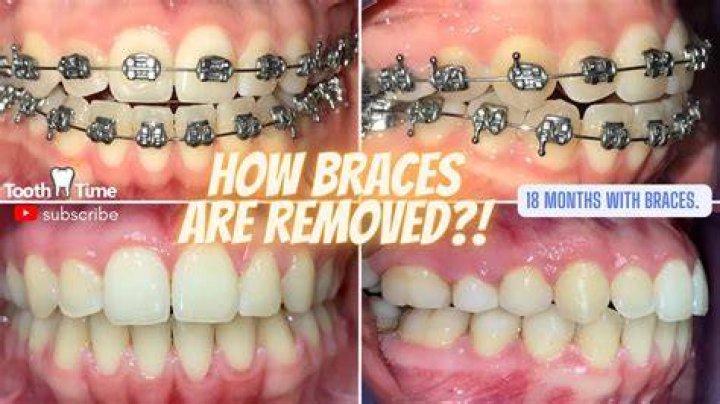 Does it hurt to have braces removed?