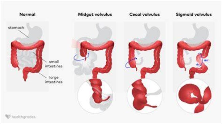 How do you know if your intestines are twisted?