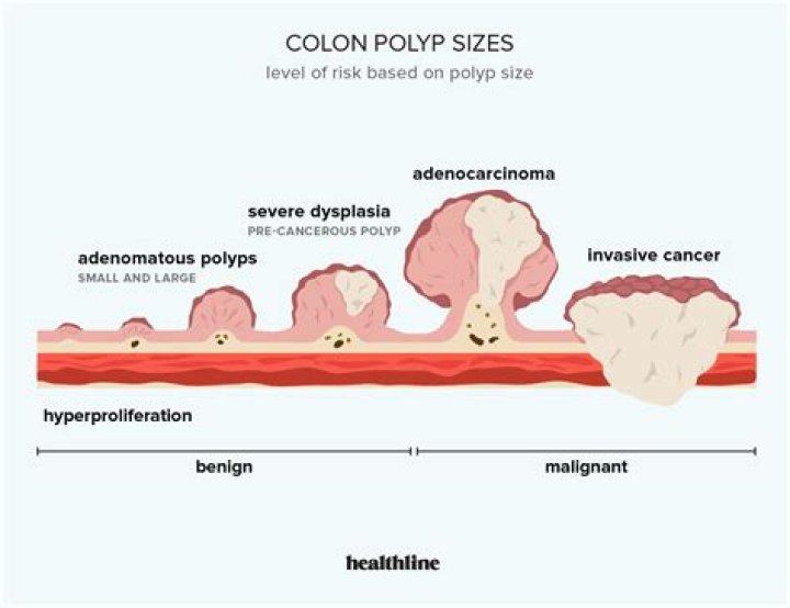 Is it normal to find polyps during colonoscopy?