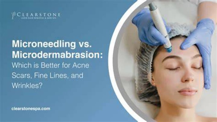 Is microdermabrasion or microneedling better for scars?