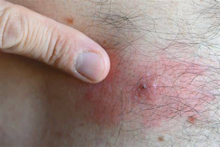 What does a tick bite look like?